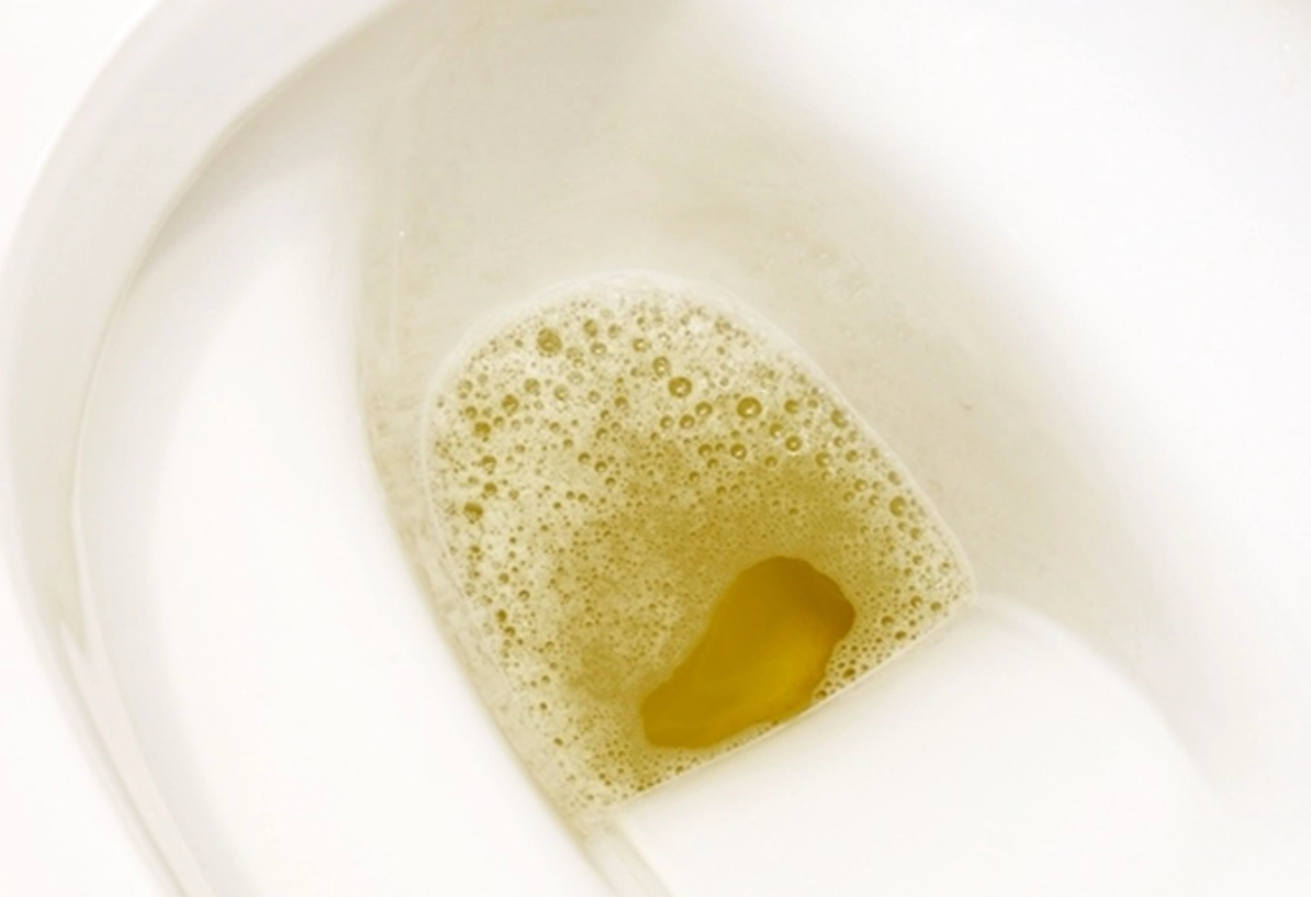 尿液有泡泡 糖尿病