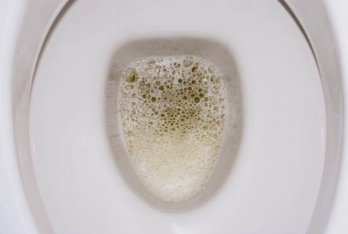 糖尿病 尿液泡泡