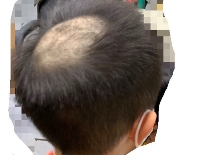 夢境解析禿頭 夢境解析禿頭