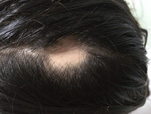 夢見自己頭頂禿一塊？解夢師教你從心理壓力到健康警訊的完整解析