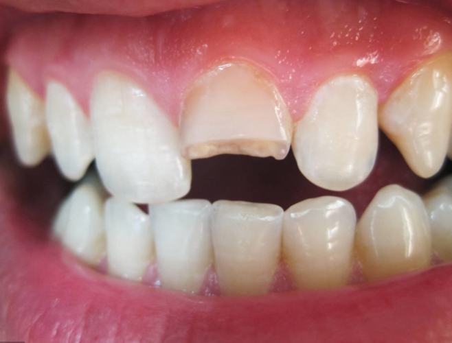 掉牙齒夢境意義 掉牙齒夢境意義