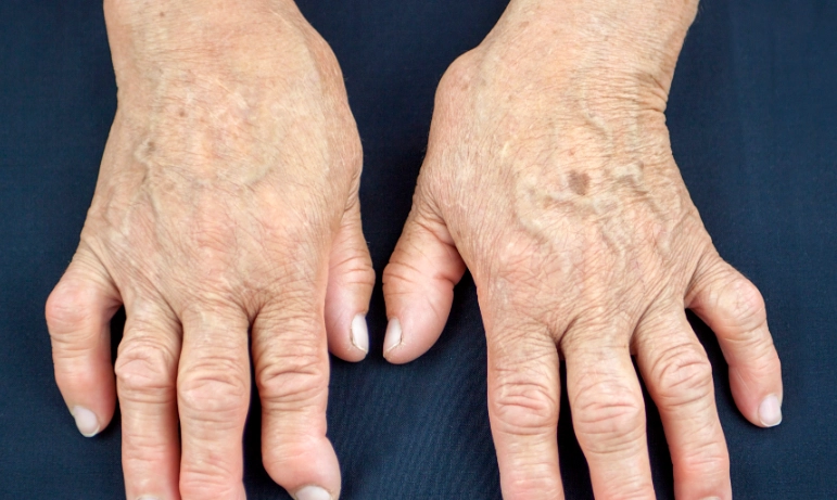 RA發病機制 RA發病機制