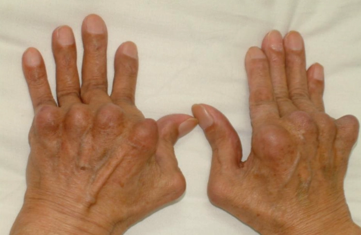 類風濕性關節炎病因 類風濕性關節炎病因