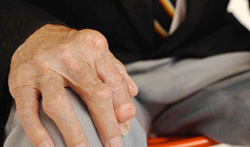 類風濕性關節炎病因 類風濕性關節炎病因