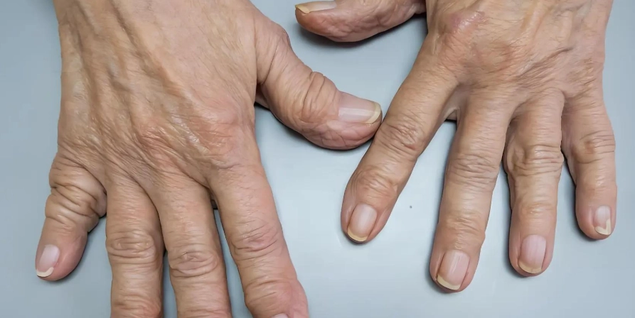 類風濕性關節炎原因 類風濕性關節炎原因