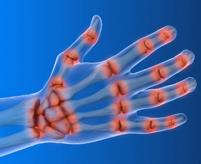 类风湿关节炎治疗 类风湿关节炎治疗