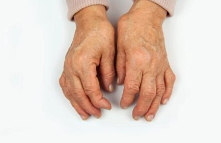 类风湿关节炎饮食建议