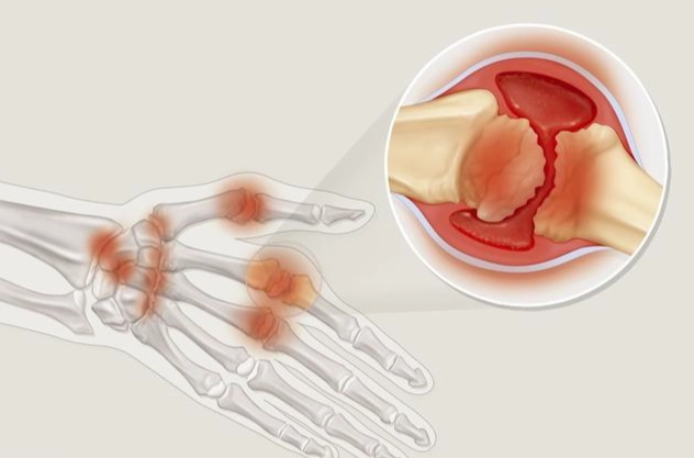 类风湿关节炎症状 类风湿关节炎症状