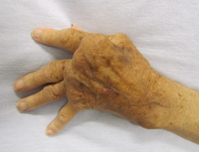 类风湿关节炎药物 类风湿关节炎药物