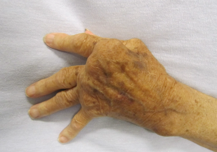 關節炎家庭療法