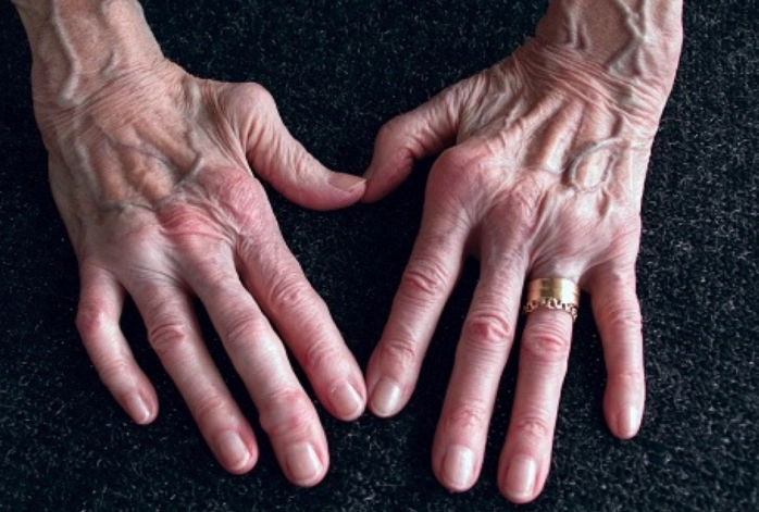 类风湿关节炎饮食禁忌