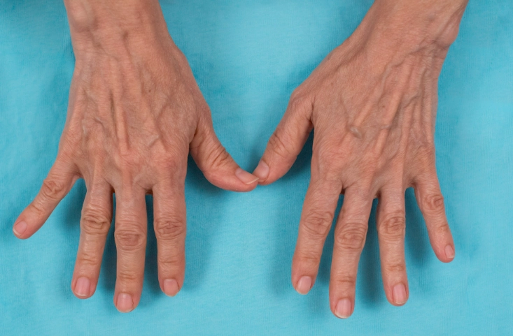 类风湿关节炎药物 类风湿关节炎药物