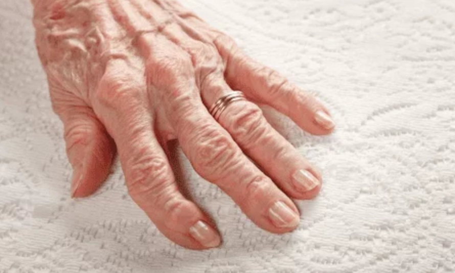 類風濕關節炎自癒