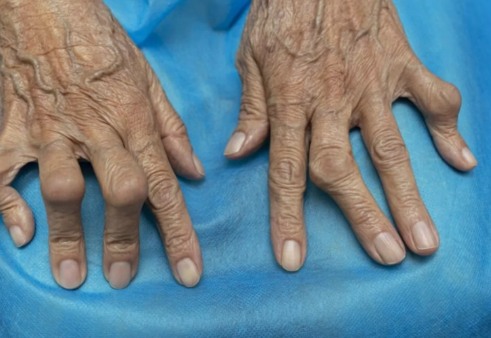 类风湿关节炎不能吃的食物