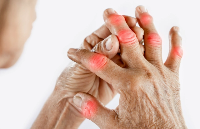 類風濕關節炎偏方