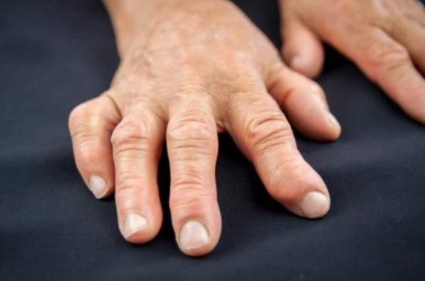 类风湿关节炎不能吃的食物