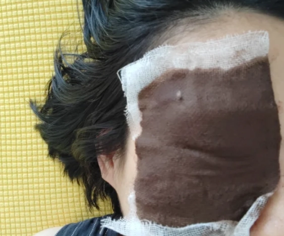 視力模糊中醫調理