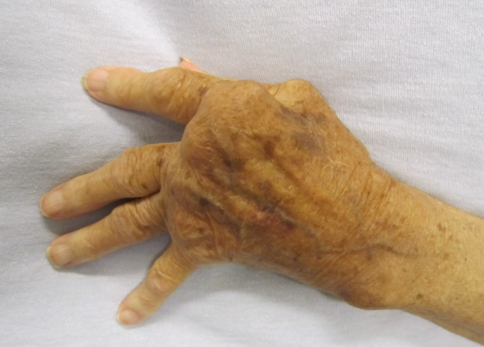 類風濕關節炎治療