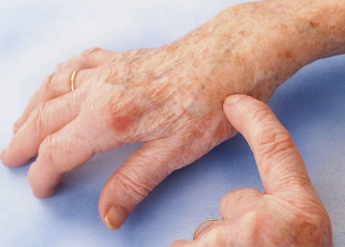 类风湿关节炎治疗 类风湿关节炎治疗