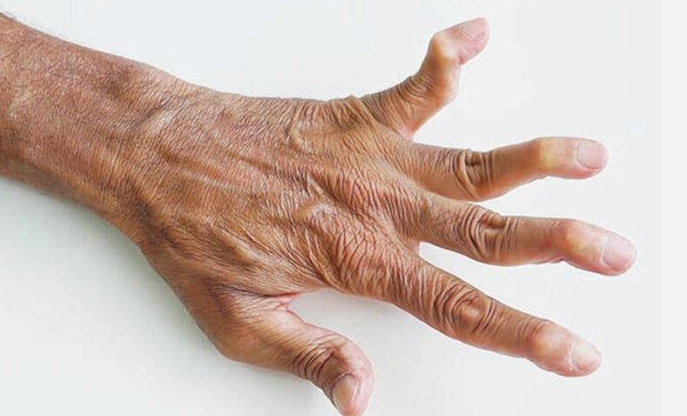 类风湿关节炎症状 类风湿关节炎症状