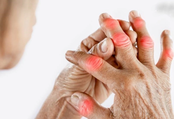 类风湿关节炎症状 类风湿关节炎症状