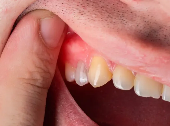 夢到牙齒鬆動解夢 夢到牙齒鬆動解夢