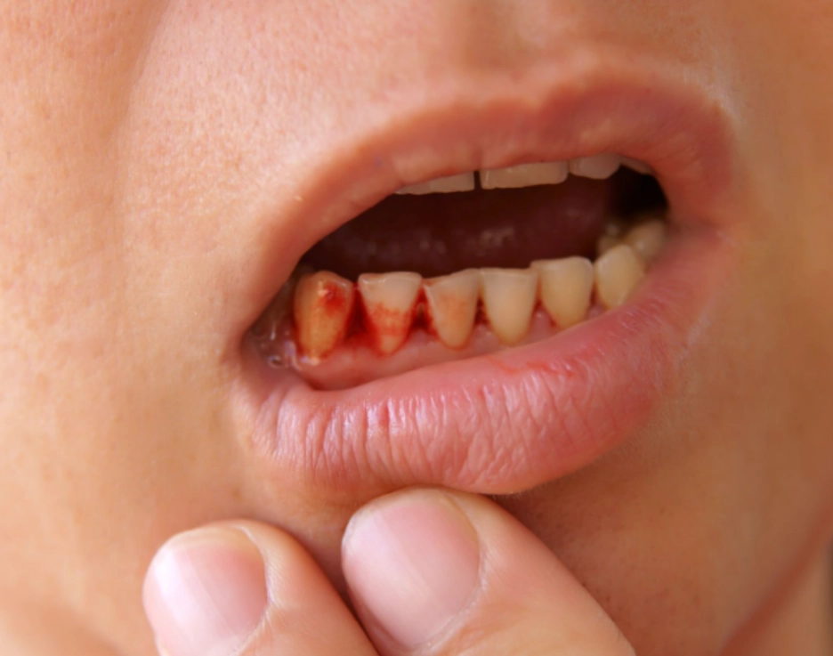 掉牙齒夢境解析 掉牙齒夢境解析