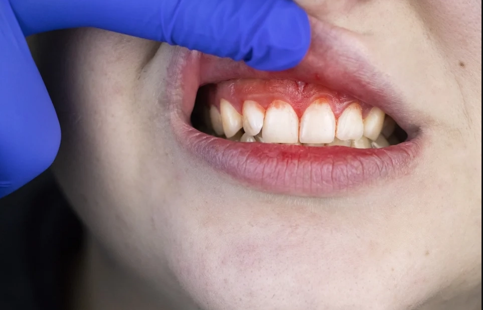 掉牙齒夢境解析 掉牙齒夢境解析