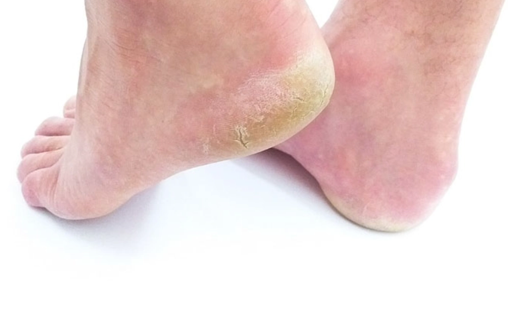 漂白水 香港腳 漂白水 香港腳