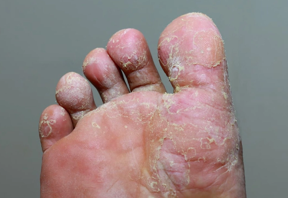 香港腳 治療 香港腳 治療