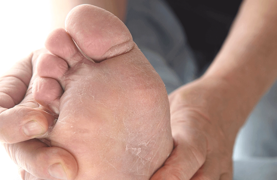 香港腳 治療 香港腳 治療