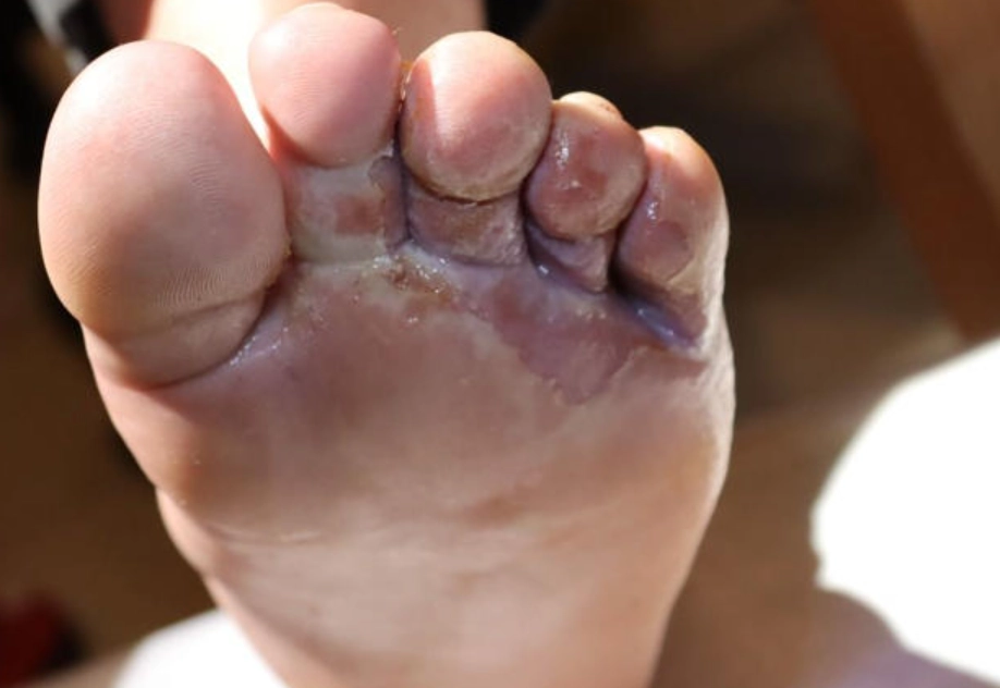 漂白水 除黴菌 漂白水 除黴菌