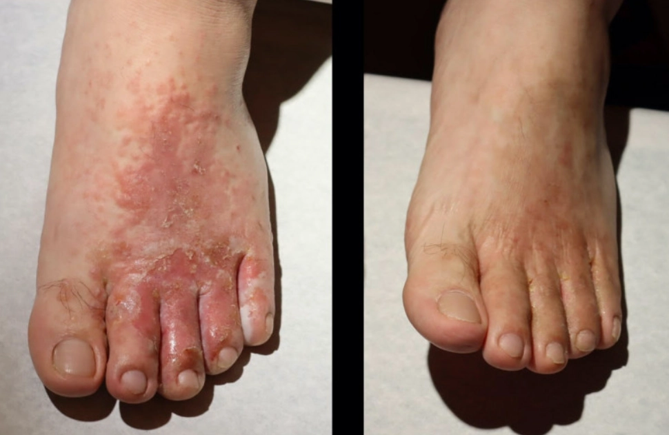 漂白水 香港腳 漂白水 香港腳