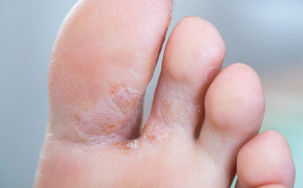 漂白水 除黴菌 漂白水 除黴菌