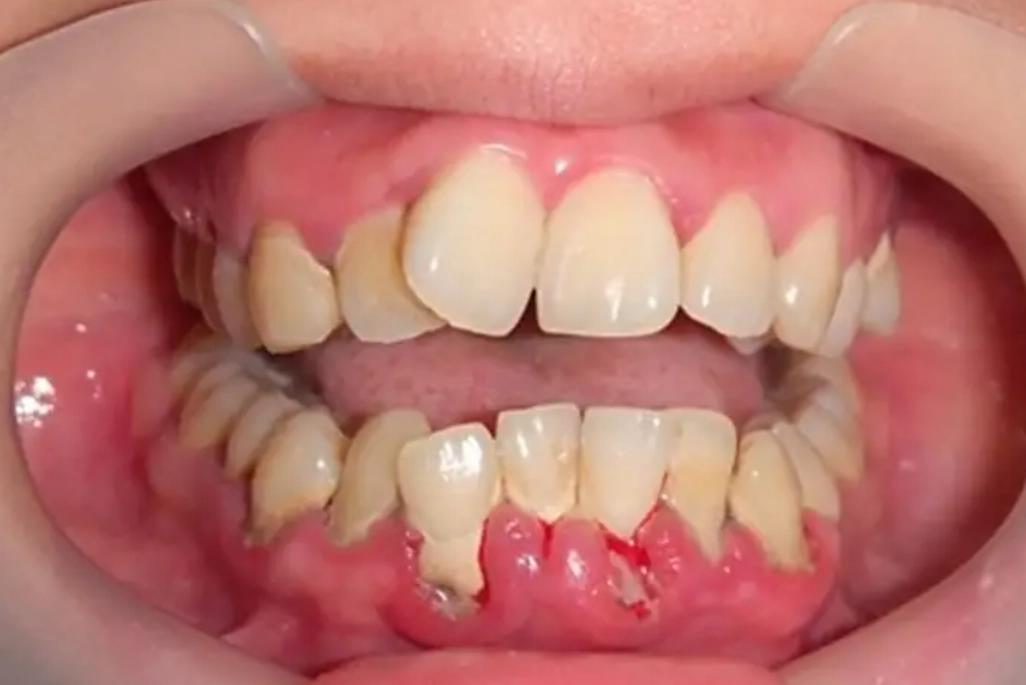 夢見牙齒鬆動出血