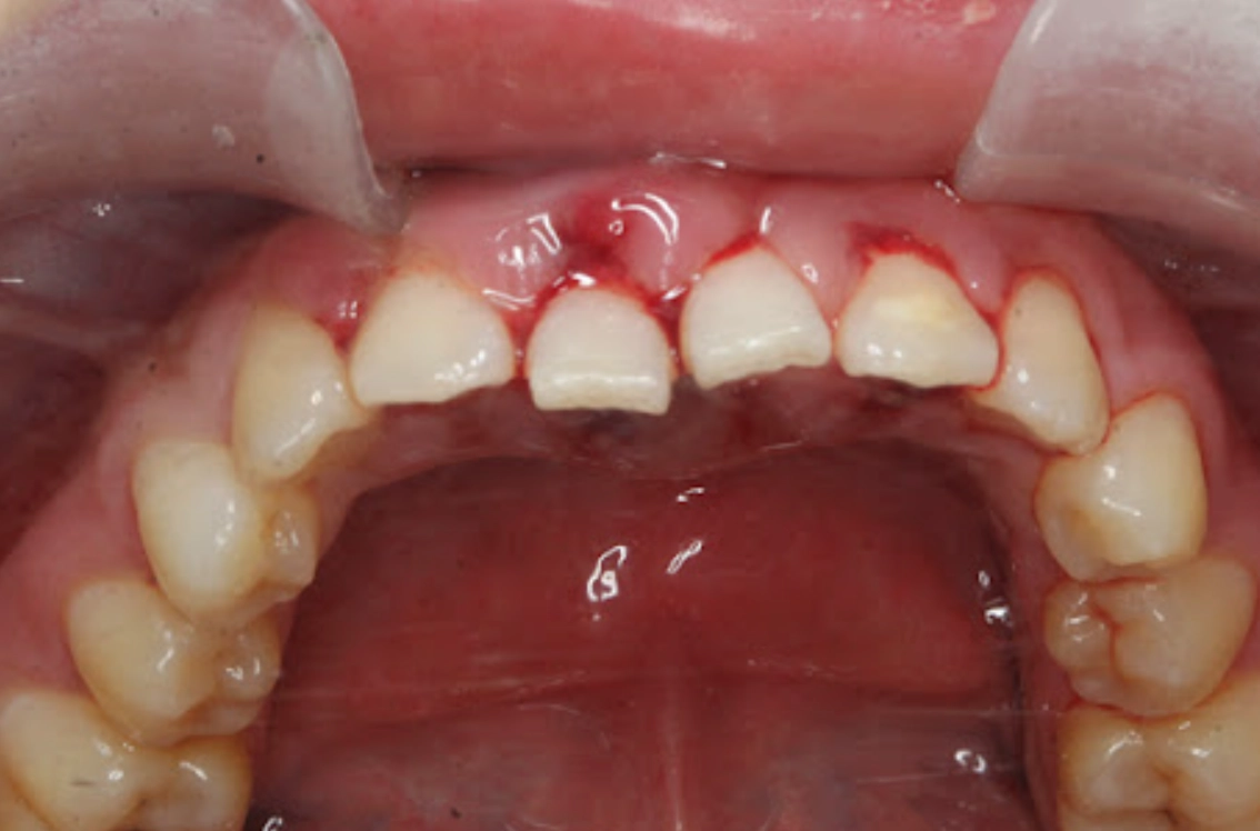 夢境牙齒脫落解夢