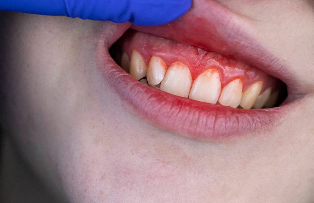 夢見牙齒鬆動出血