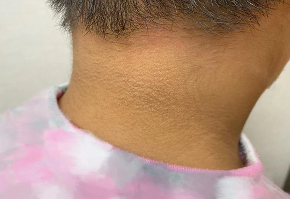 糖尿病皮膚症狀