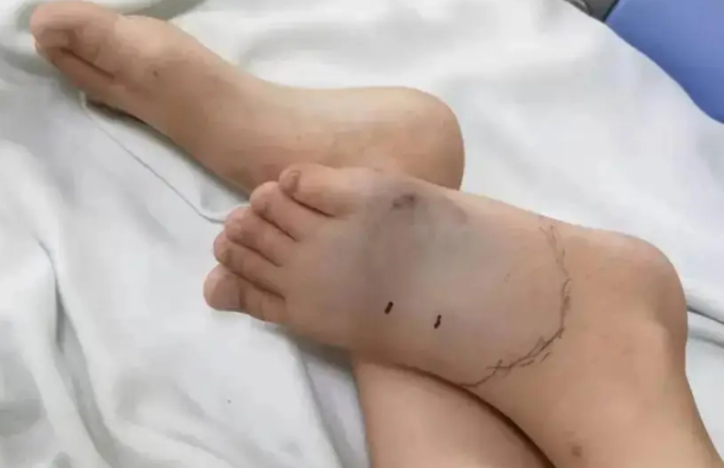 夢見被蛇咬腳 解夢 夢見被蛇咬腳 解夢