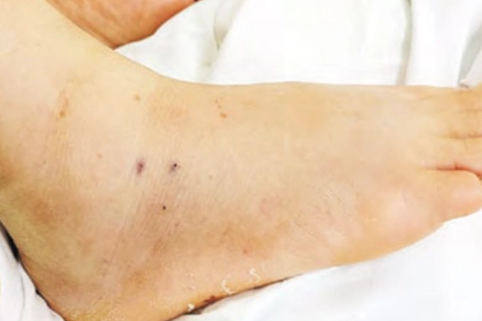 夢見被蛇咬腳 心理學 夢見被蛇咬腳 心理學