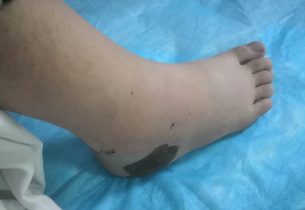 夢見被蛇咬 象徵