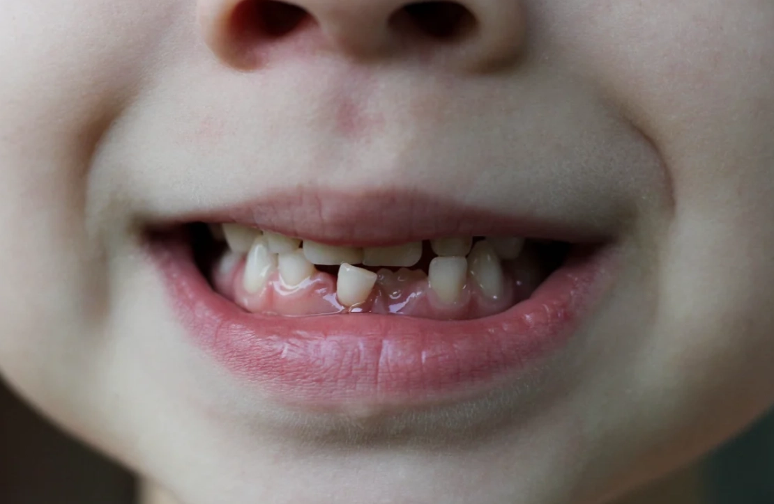 牙齒脫落夢境 牙齒脫落夢境