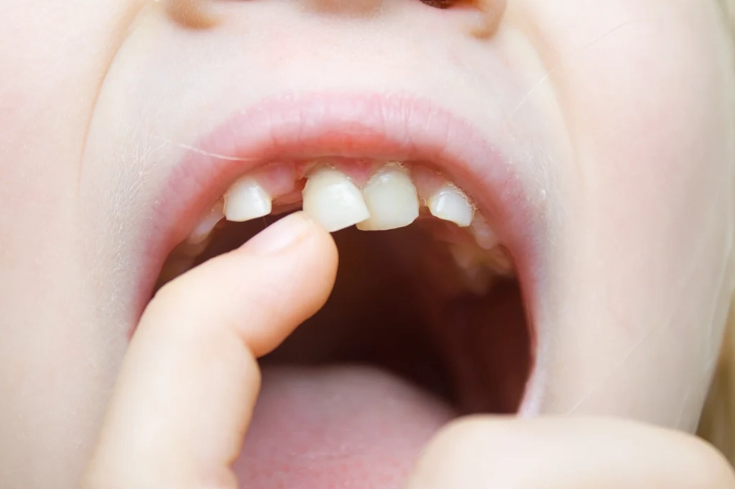 夢見掉牙齒 夢見掉牙齒