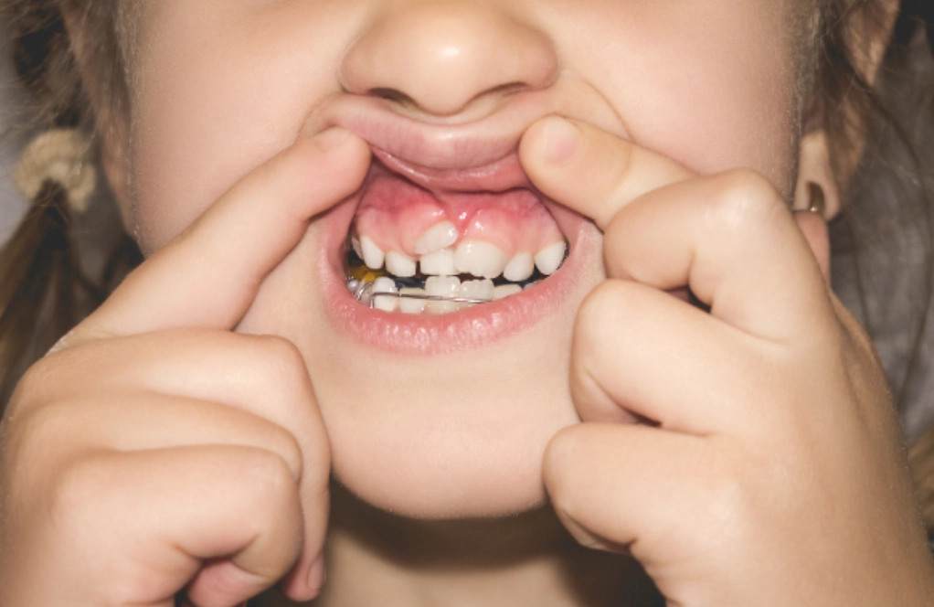 夢見掉牙齒 夢見掉牙齒