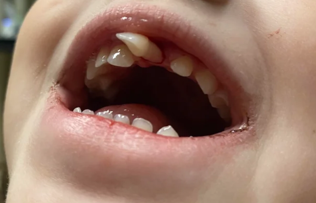 牙齒脫落夢境 牙齒脫落夢境